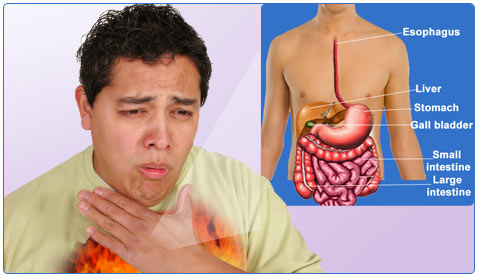 Indigestion Or Dyspepsia - Causes, Symptoms, Diagnosis ...