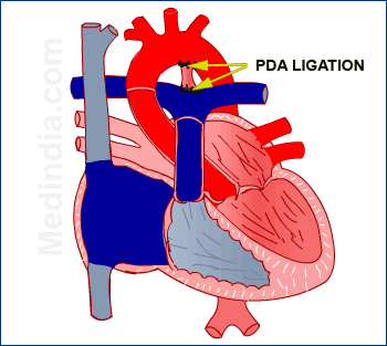 pda ligation