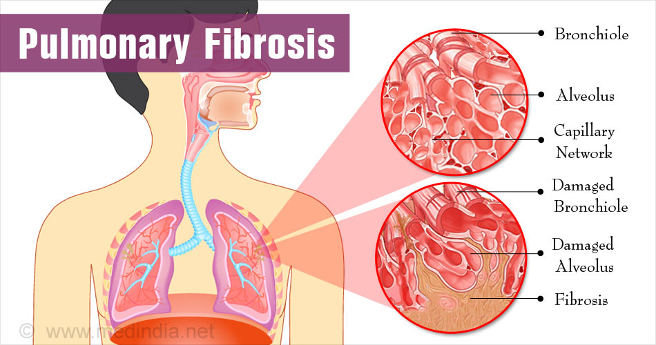 Lung fibrosis