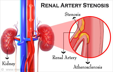Renal arter stenozu