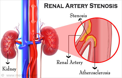 Sténose de l'artère rénale