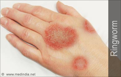 Ringworm Image