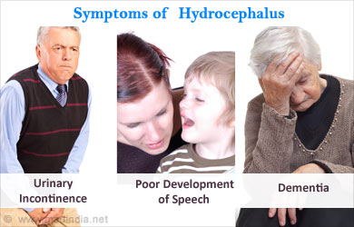 hydrocephalus symptoms diagnosis treatment medindia patients patientinfo