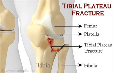 Tibial Plateau Bumper Fracture Symptoms Causes