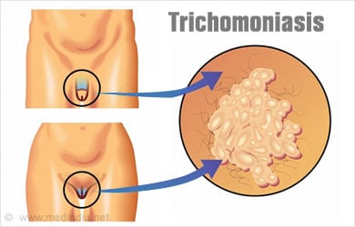 hogy a Trichomonas szaporodik e