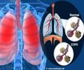 Diet for Obstructive Lung Disease