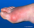Foods to Avoid in Gout