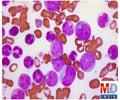 Leukemia / Blood Cancer
