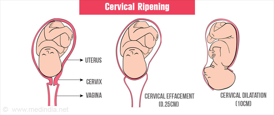 Cervical Effacement and Dilatation