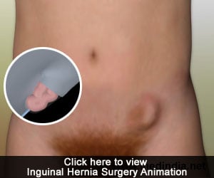 Inguinal Hernia surgery animation