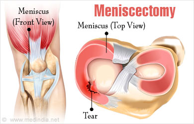 Meniscectomy - Types, Treatment, Risk, Recovery, Tips