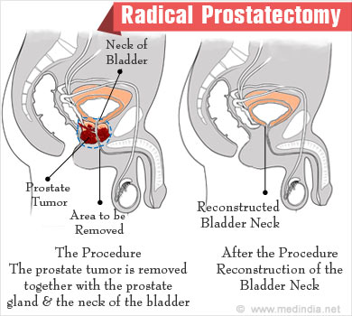 prostatitis cronica bacteriana tiene cura