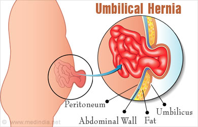 🥇 NYC Umbilical Hernia Treatment, Surgery, Symptoms, Causes